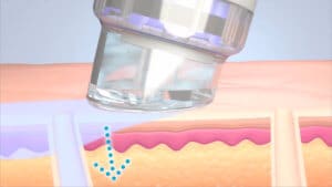 HydraFacial™ Schritt 4 HydraFacial™ Schritt 4