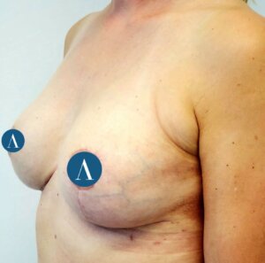 brustimplantate entfernen